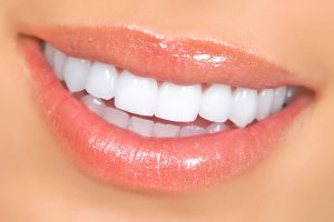 porcelain veneers